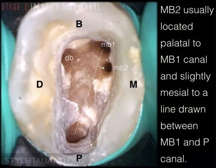 以便我们可以回答上颌第一磨牙是否有3个牙根和4根根管(mb1,mb2,db,p)