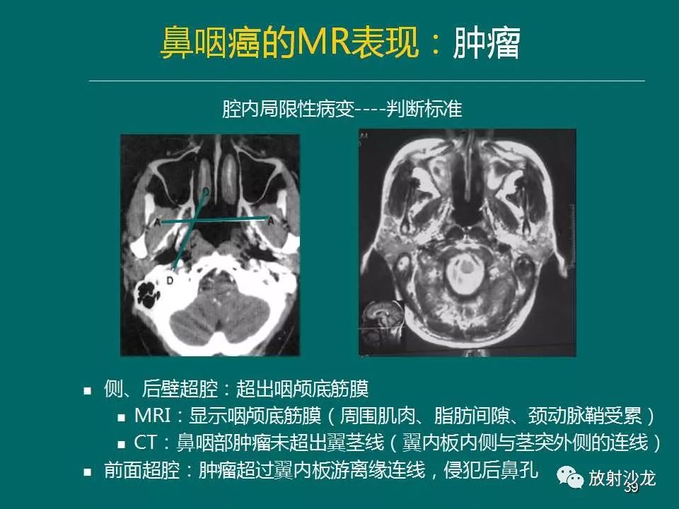 鼻咽癌的mri诊断