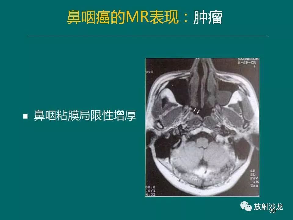 鼻咽癌的mri诊断