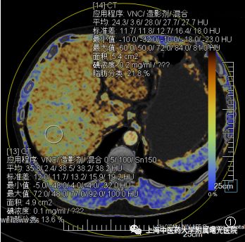 【曙光·新闻】双源CT，让你直接“看”到脂肪肝