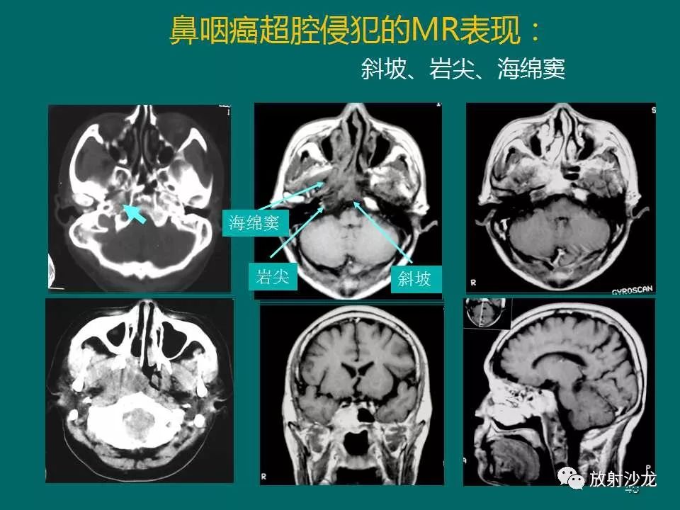 鼻咽癌的mri诊断