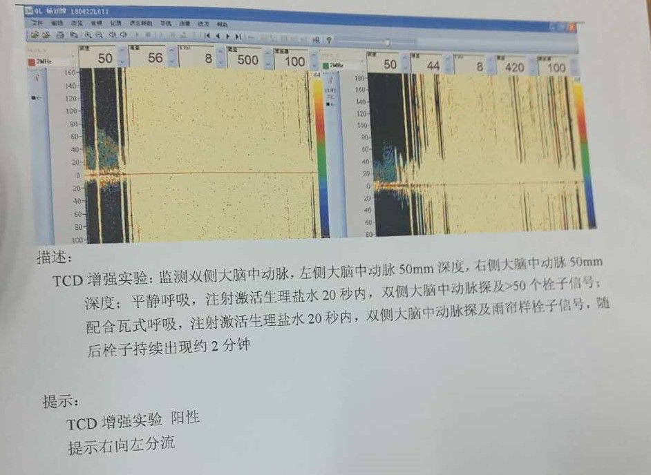 对比增强经颅内多普勒超声声学造影结果阳性,提示右向左分流