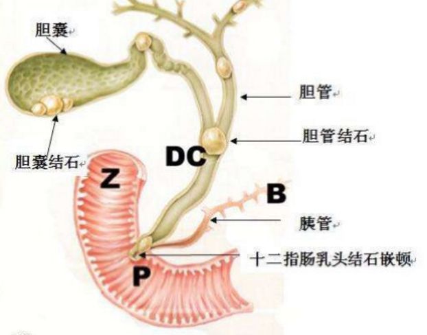 我是一颗小小的石头,深深地埋在胆管之中