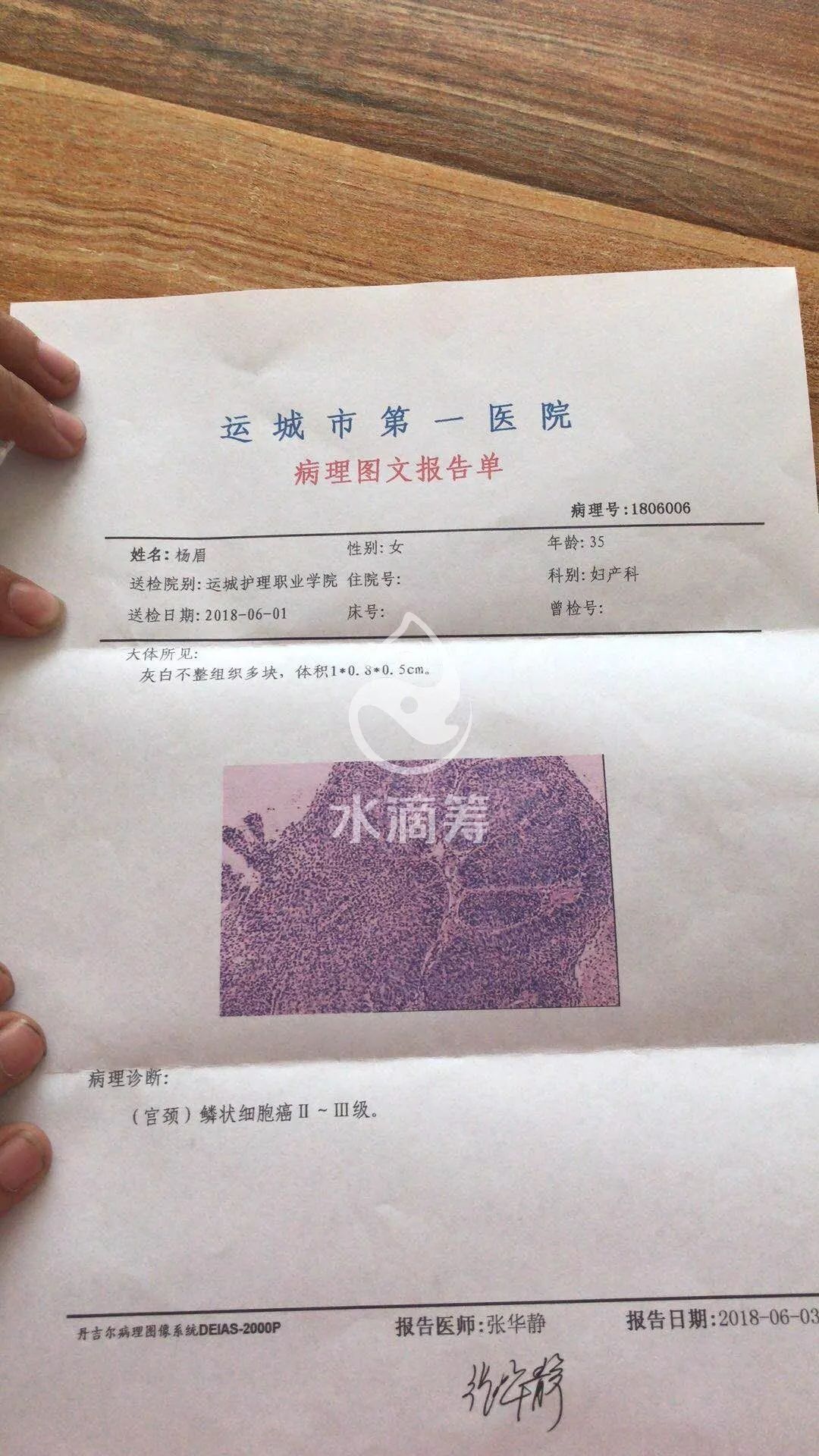 去运城护理职业学院附属医院检查,确诊为宫颈鳞状细胞癌,做了子宫切除