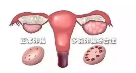 痤疮的形成原理示意图_痤疮形成阶段示意图(3)