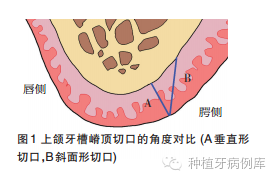 (图1)斜面形切口:是指刀刃与骨面成近似45°角.