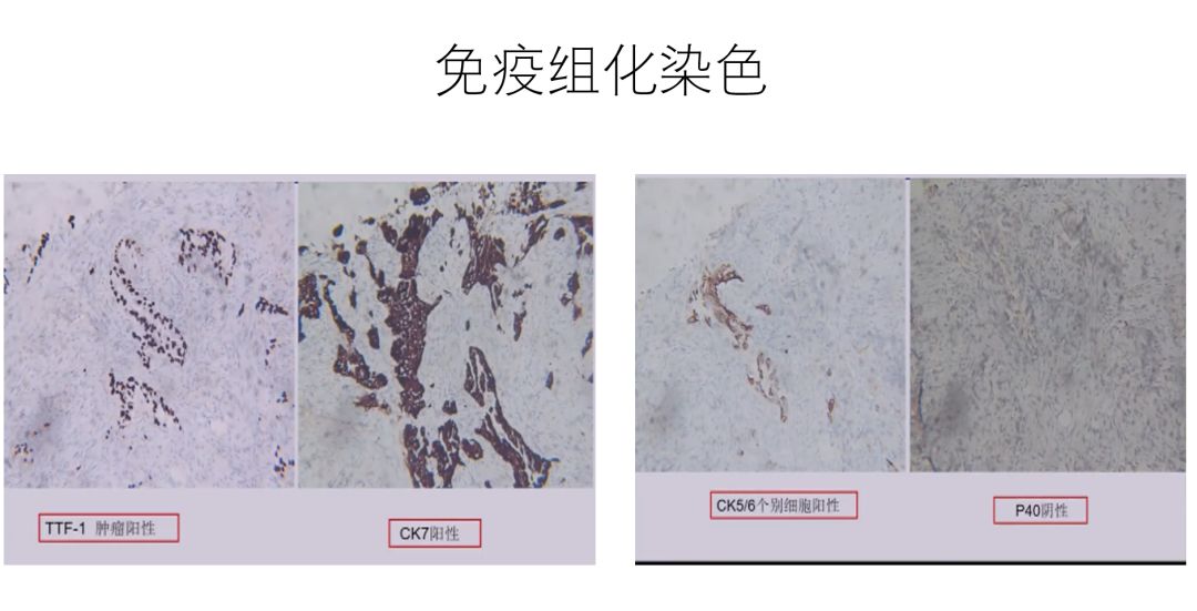 肺癌病例∣一例双肺原发性癌的病例讨论