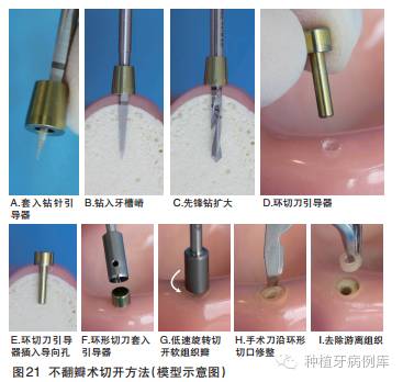 钻扩大孔洞形成导向孔,再将软组织环切刀引导器(其直径应与所选种植体