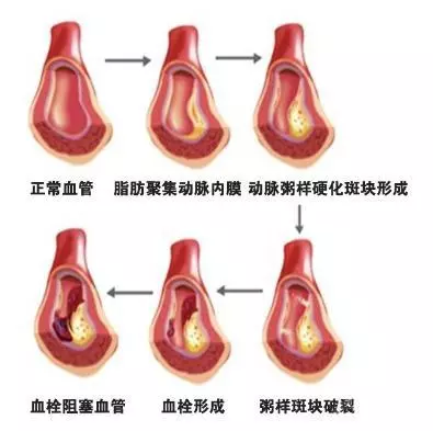 世上疾病都与瘀和堵有关!