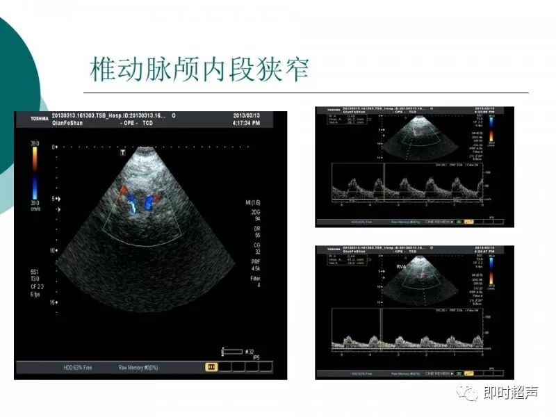 超声在脑卒中筛查的临床应用