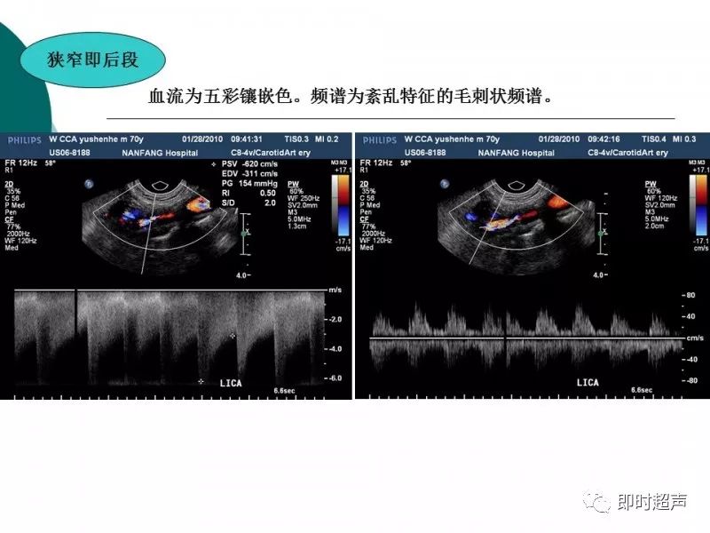 超声在脑卒中筛查的临床应用