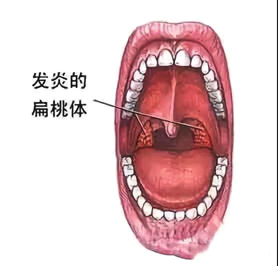 四,腺样体过于肥大的症状危害