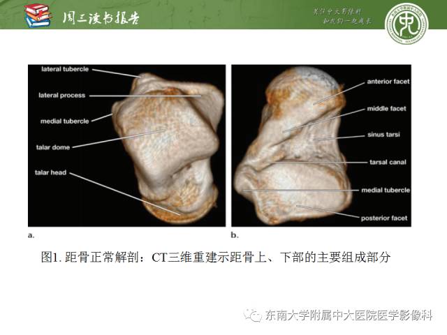 距骨骨折与脱位放射科医师及时诊断与分类指南