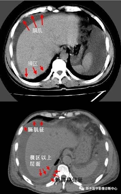 4,肝裸区征:肝的背侧内部肝与膈肌直接相贴,此为裸