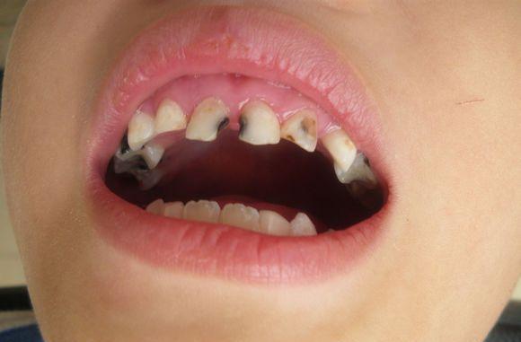 七岁小孩牙齿黑不换牙怎么办?