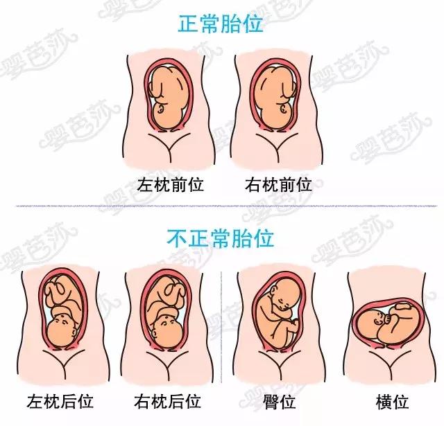 胎位正常:常见的正常胎位是枕前位(分为左枕前位和右枕前位,指宝宝