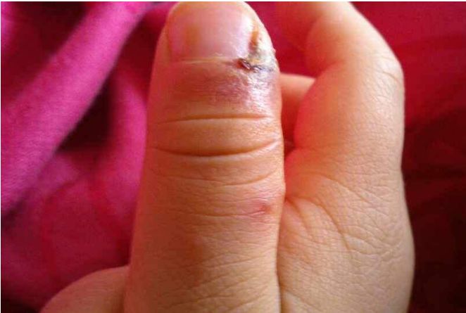 脓性指头炎,是指手指末节掌面的皮下化脓性感染,多由刺伤引起,致病菌