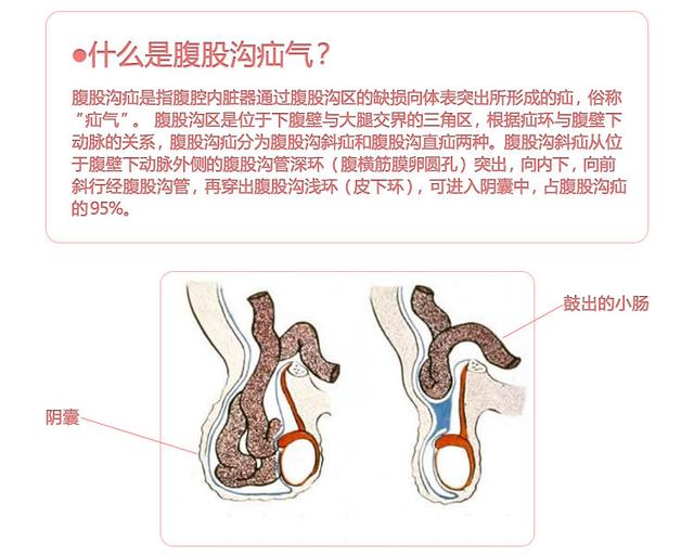 小儿疝气食疗怎么调理?宝妈们一定要学学