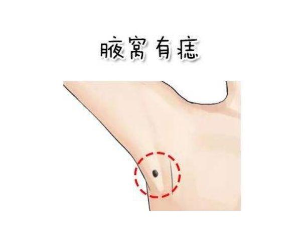 腋下长痣代表的是什麽意思?长肉疙瘩痣要不要手术