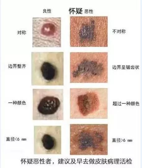 面积比较大:直径超过1.5厘米的黑痣有恶变的可能性非常大.