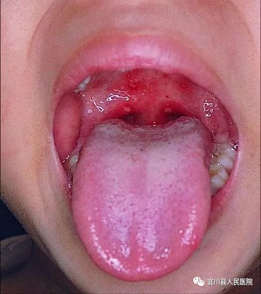 小孩口腔疱疹怎么治疗