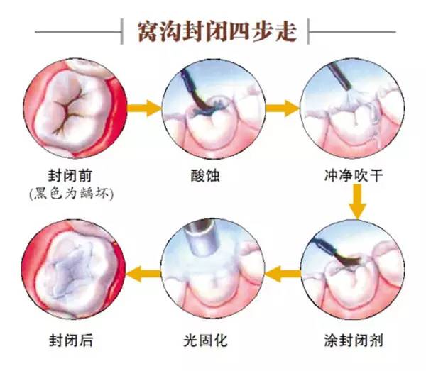 窝沟封闭好不好