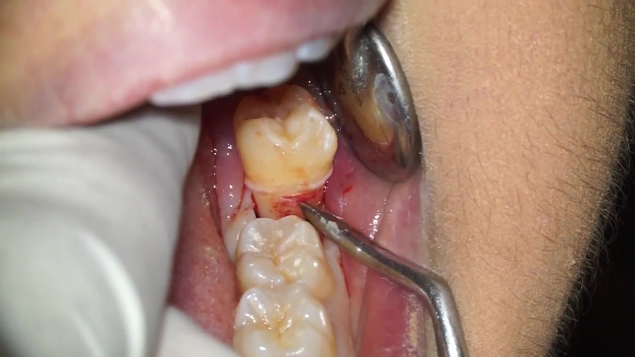拔智齿后,牙洞多久能愈合?