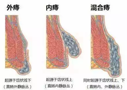 涨姿势假如得了痔疮或便秘你该这么做