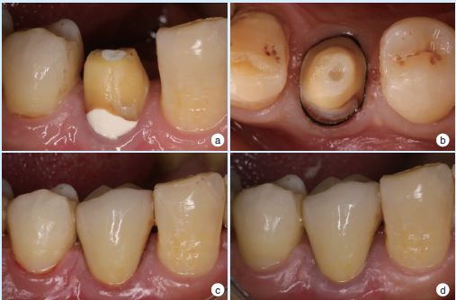 病例分享下颌第一前磨牙3牙根3根管临床报告及文献回顾