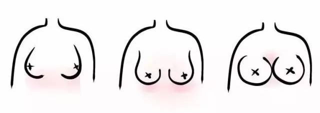 五种形状的胸部,女性请自行对号入座