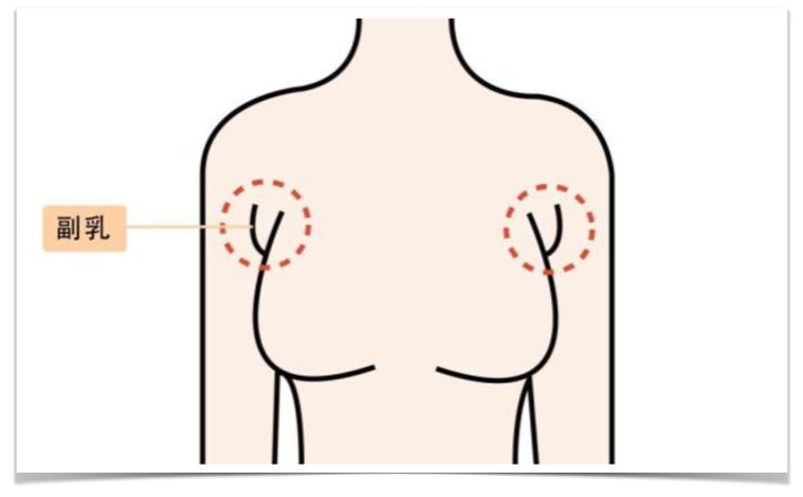 天(假性)类型,或因穿着不当,或由于体态问题,让脂肪在腋下堆积