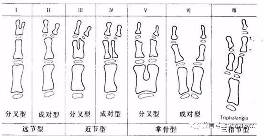 【烧伤整形科】关于"六指"宝宝的那些事儿