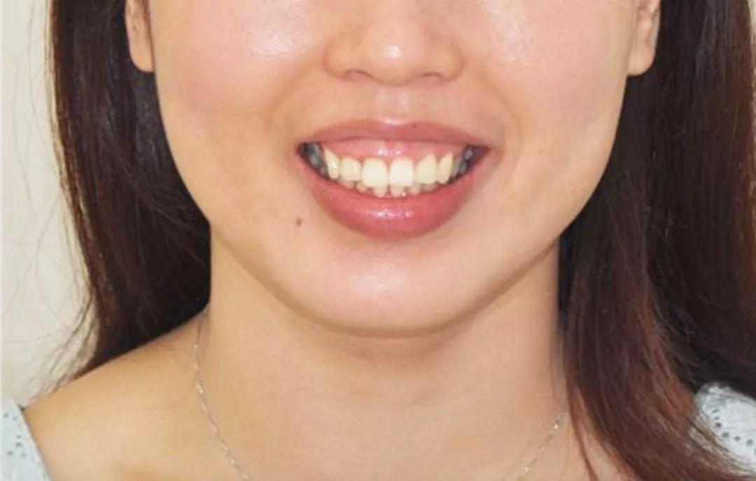 牙齿正常萌出时,牙龈向牙根方退缩.
