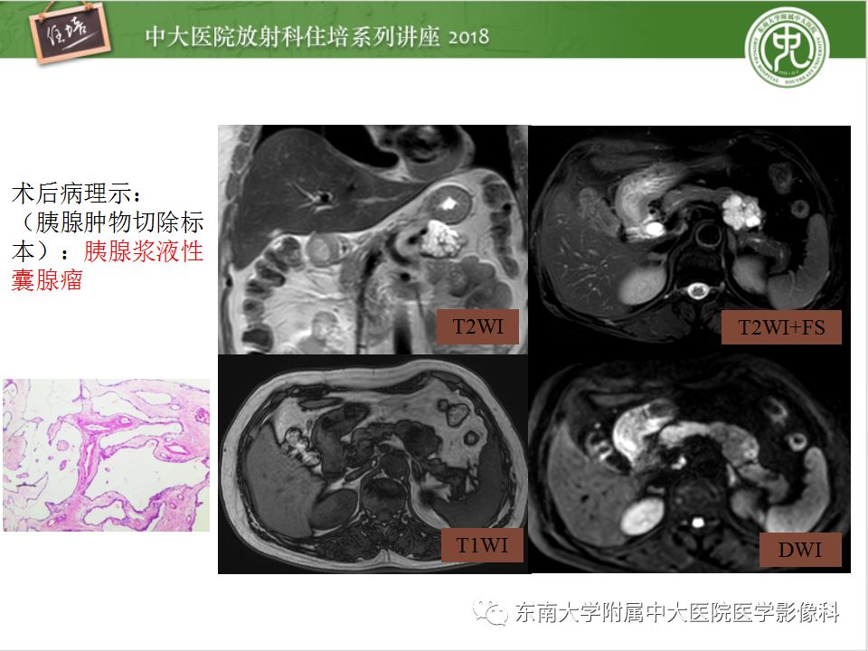 胰腺常见占位病变影像诊断思路