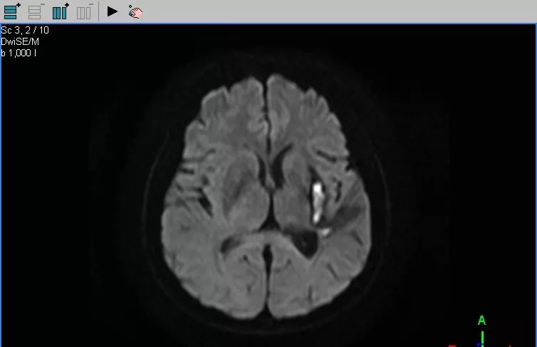 病例1——左外囊出血脑出血(cerebral hemorrhage)是指非外伤性脑实质