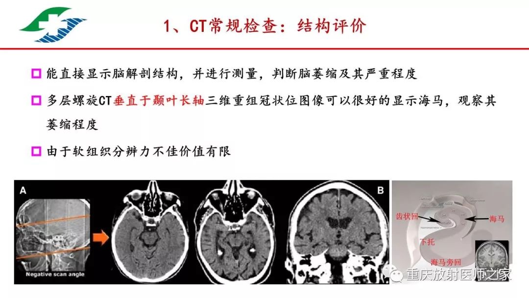 痴呆的影像学诊断