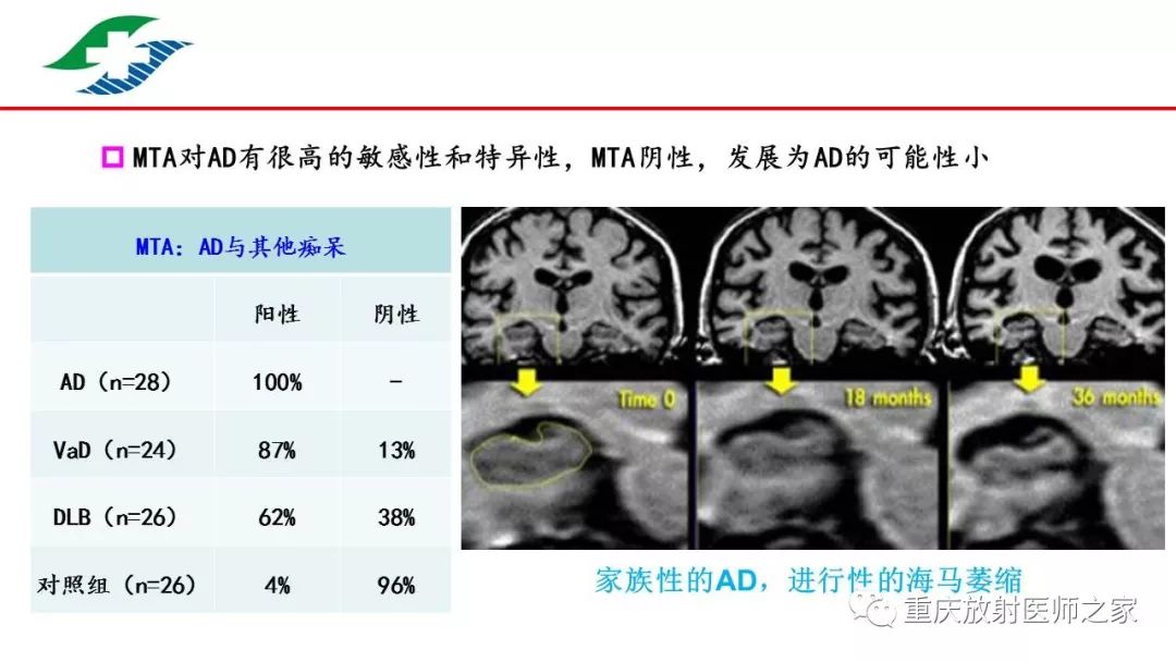 痴呆的影像学诊断