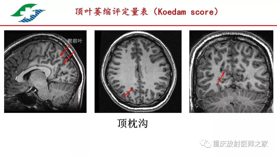 痴呆的影像学诊断