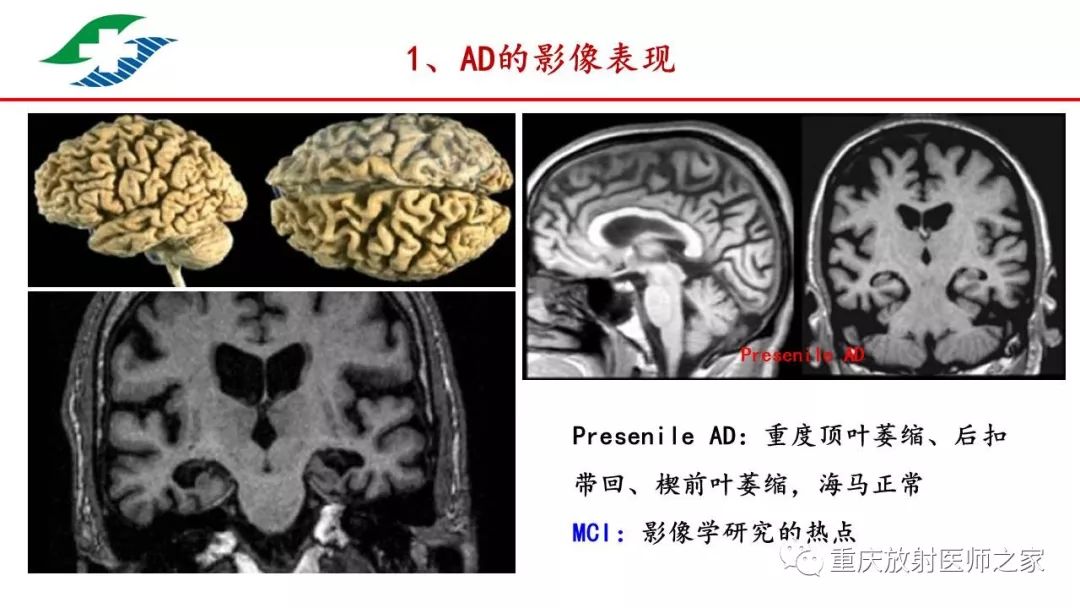 痴呆的影像学诊断