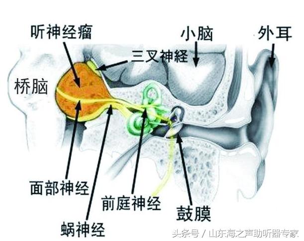 摘除早期听神经瘤不仅可以痊愈还可保留听力