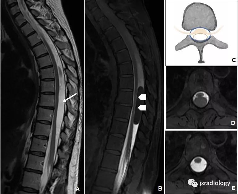 椎管内囊性病变诊断和分类