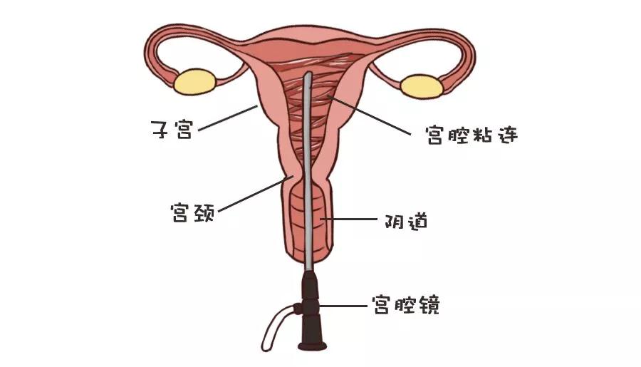 杭州妇科专家解答:宫腔粘连怎么治疗?再次粘连怎么办