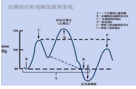 前沿技术主动脉内球囊反搏结构及工作原理