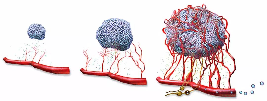 因此,伴随着肿瘤生长,就必须不断有新的血管生成,把氧气,养料等必备
