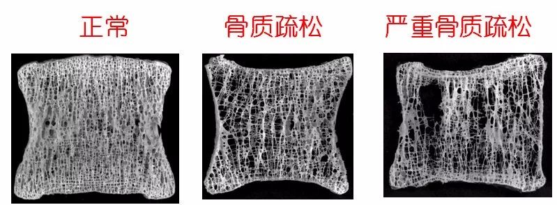 【科普】骨质疏松知多少?