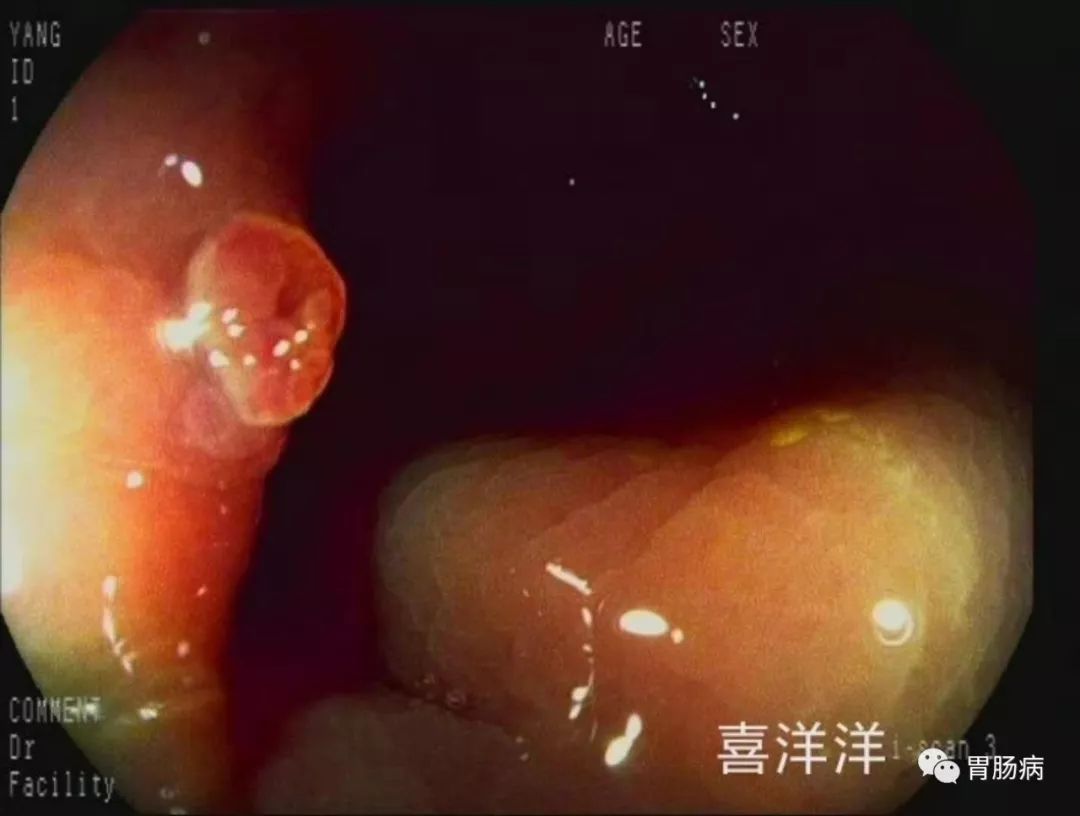 最肉的赘_得了胆结石必须切掉胆囊吗 关于胆囊切除,这些 实情 你需要知