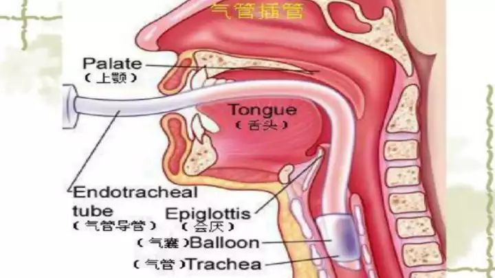 四種方法教會你做好人工氣道的管理！ 生活 第6張