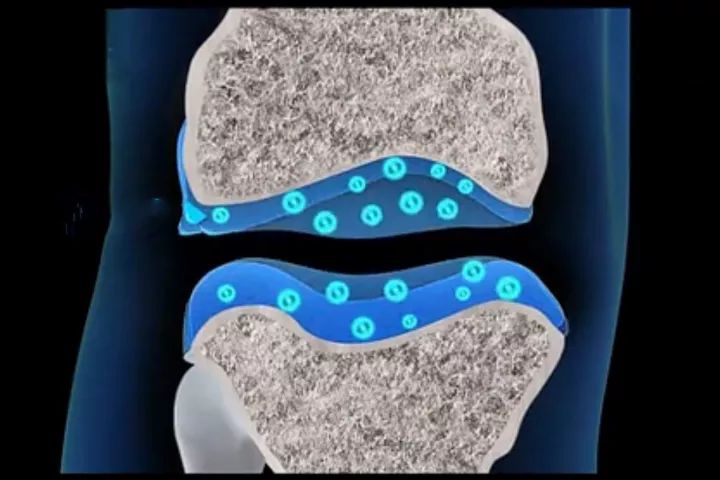神奇的干细胞疗法修复膝关节软骨