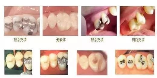 揭秘补牙全过程你的牙齿到底经历了什么