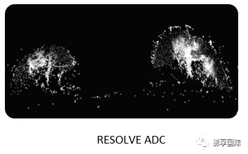 提高乳腺癌诊断精准性的黑科技resolve解剖弥散乳腺病例点评